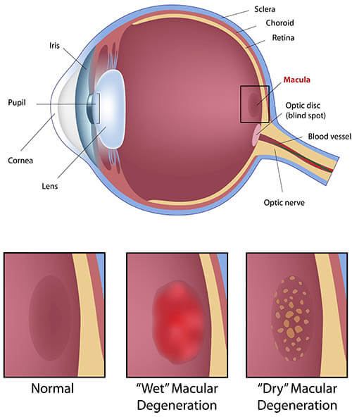 Chart Illustrating Macular Degeneration in an Eye