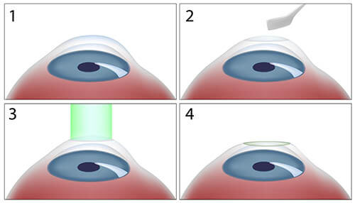 Chart Illustrating the PRK Surgery Process